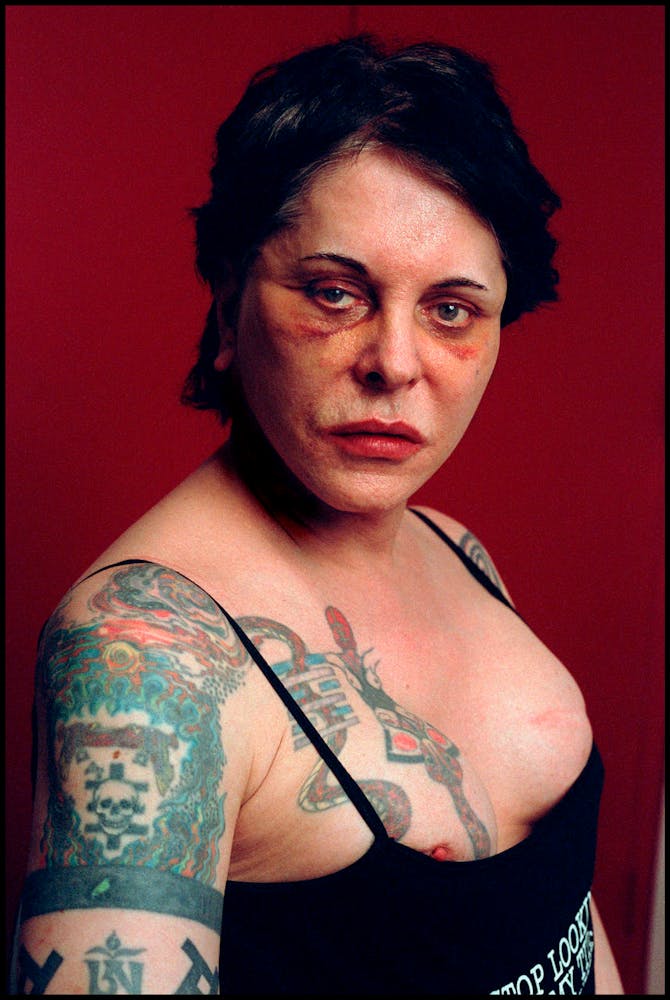 An adult with injuries from facial plastic surgery looks at teh viewer.