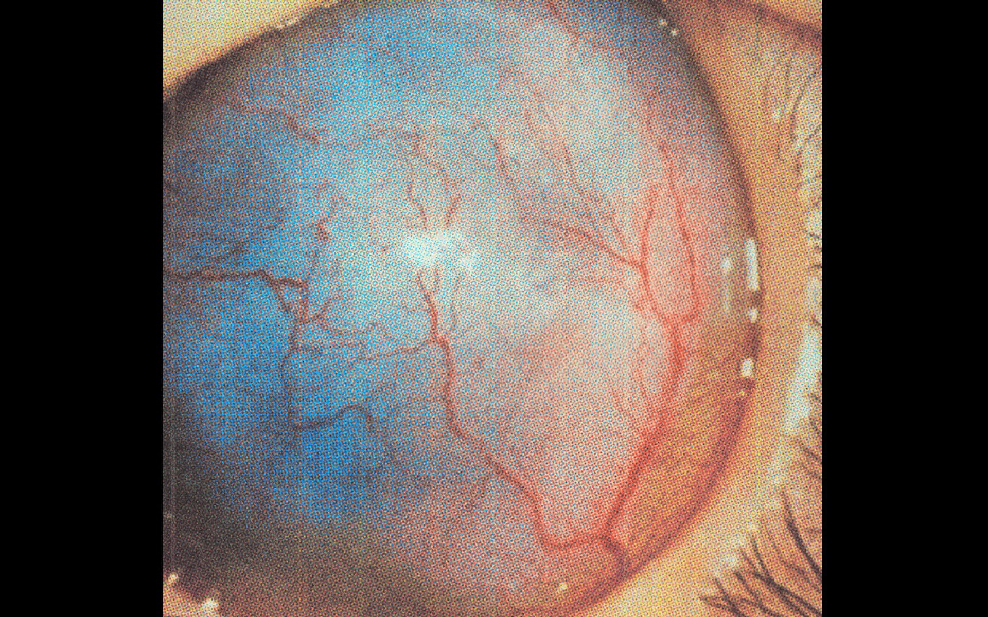 Image of eyeball with no cornea, iris, or pupil