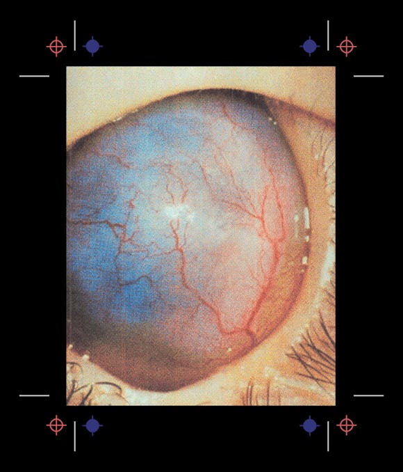 Image of eyeball with no cornea, iris, or pupil